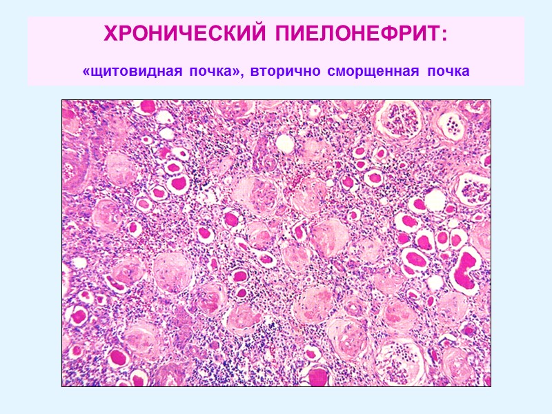 ХРОНИЧЕСКИЙ ПИЕЛОНЕФРИТ:  «щитовидная почка», вторично сморщенная почка